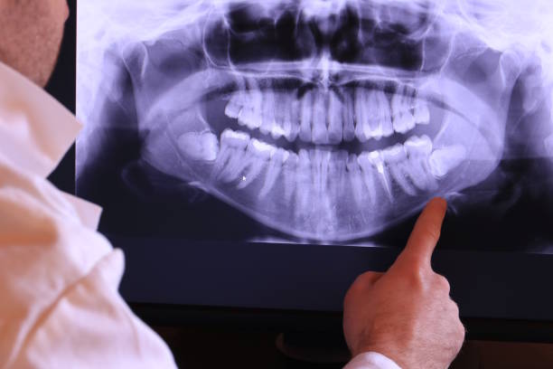 Best Knocked-Out Tooth (Avulsed Tooth) Treatment in Celina, OH